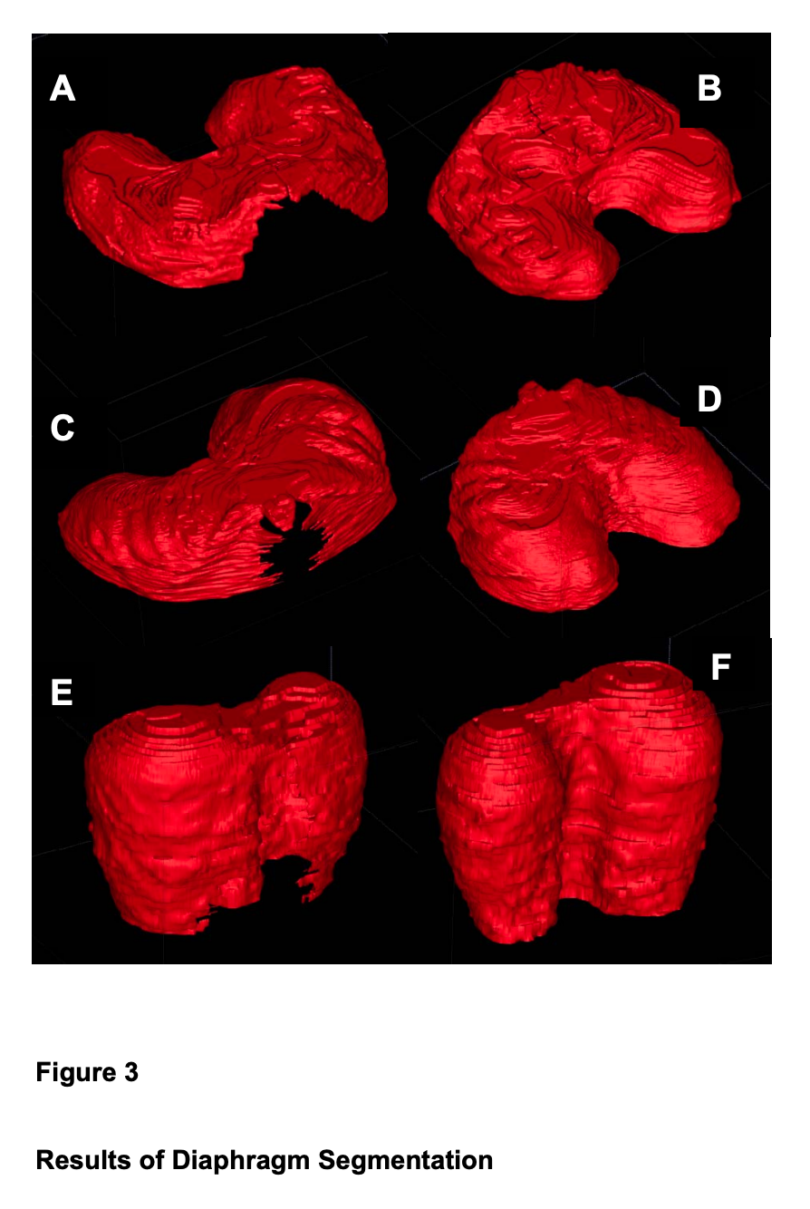 Diaphragm Segmentation in CT Images: A Review of Mathematical and Computational Methods