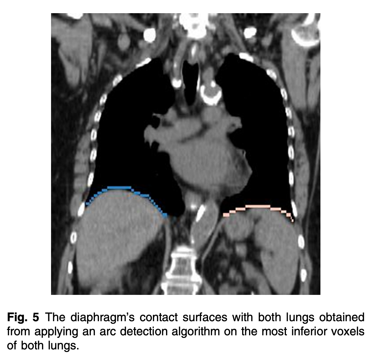 Diaphragm Segmentation in CT Images: A Review of Mathematical and Computational Methods