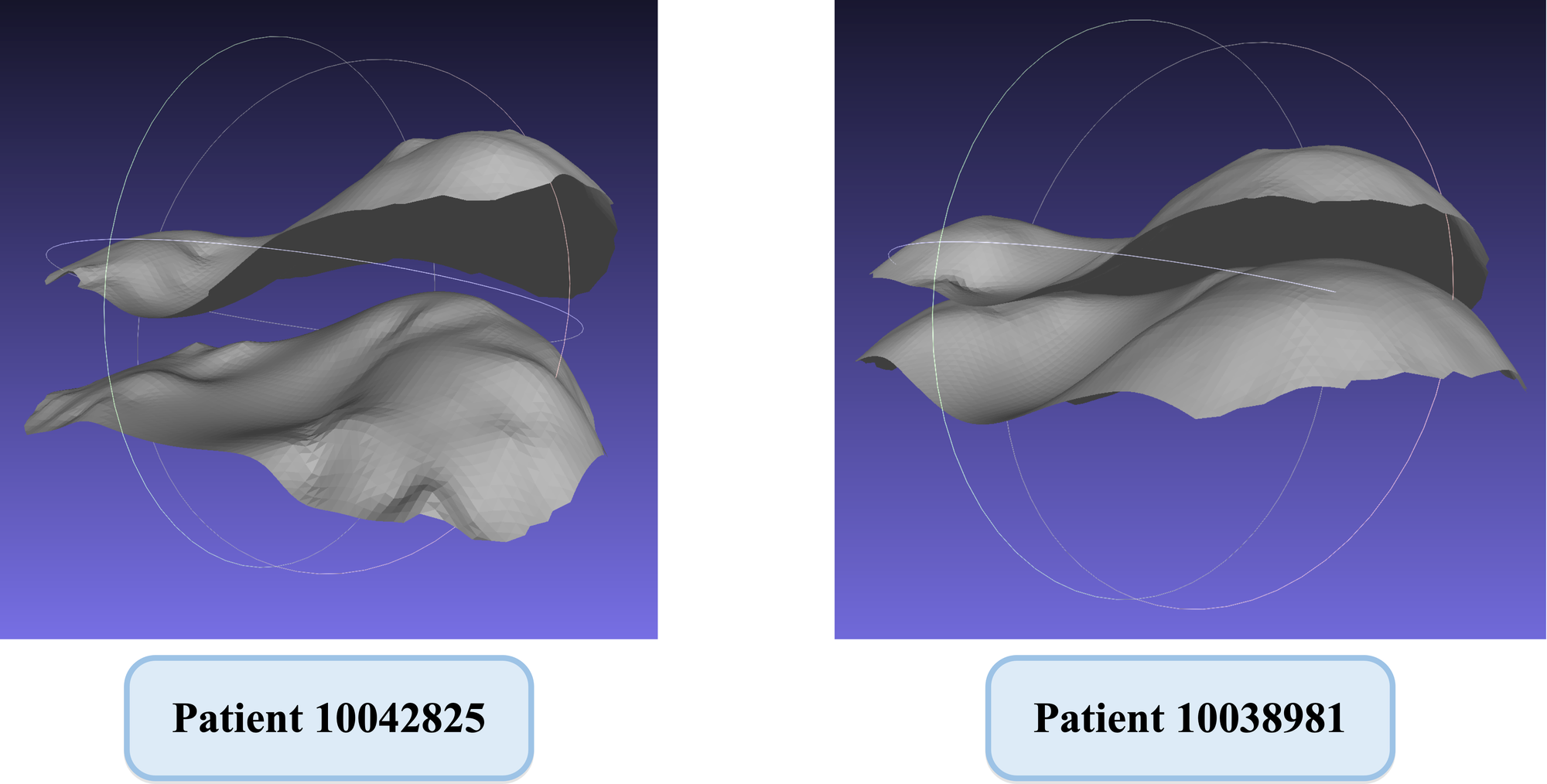 Diaphragm Function Evaluation in COPD Patients Using Chest CT Image Analysis