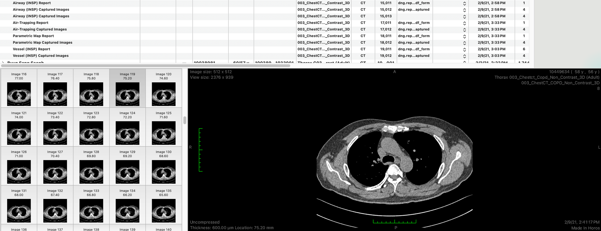 Diaphragm Function Evaluation in COPD Patients Using Chest CT Image Analysis